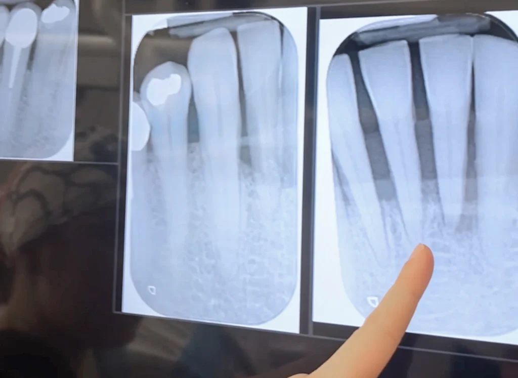 Cosa fare se si rompe un dente improvvisamente? 1 dente rotto