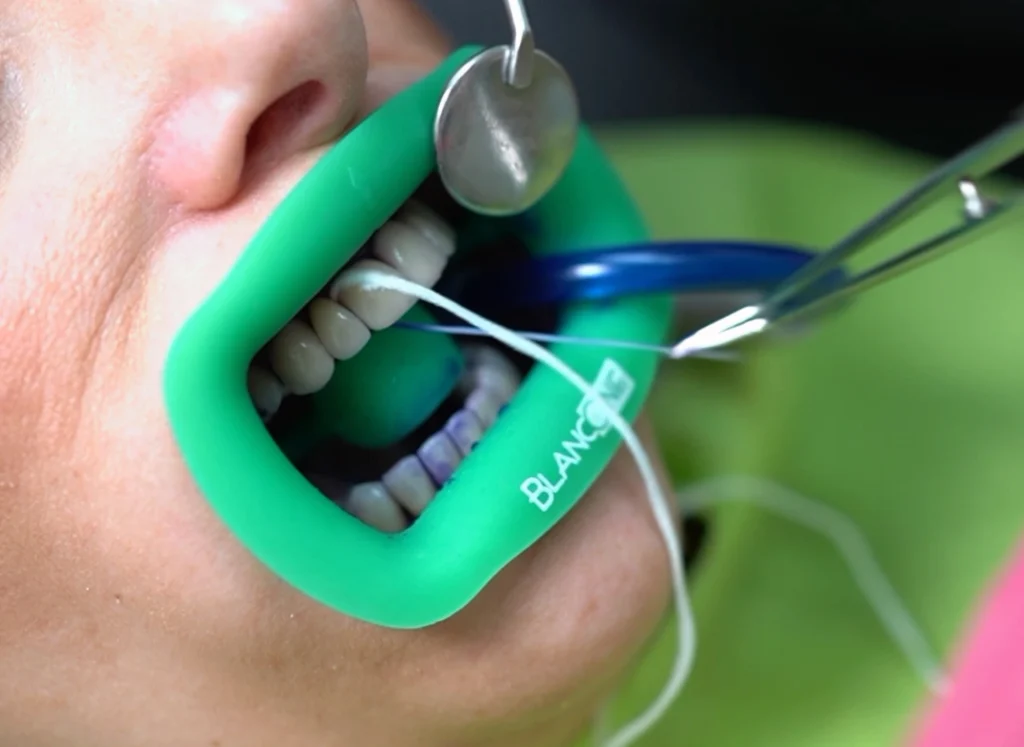Pulizia dentale moderna: perché scegliere la GBT 1 pulizia dentale moderna