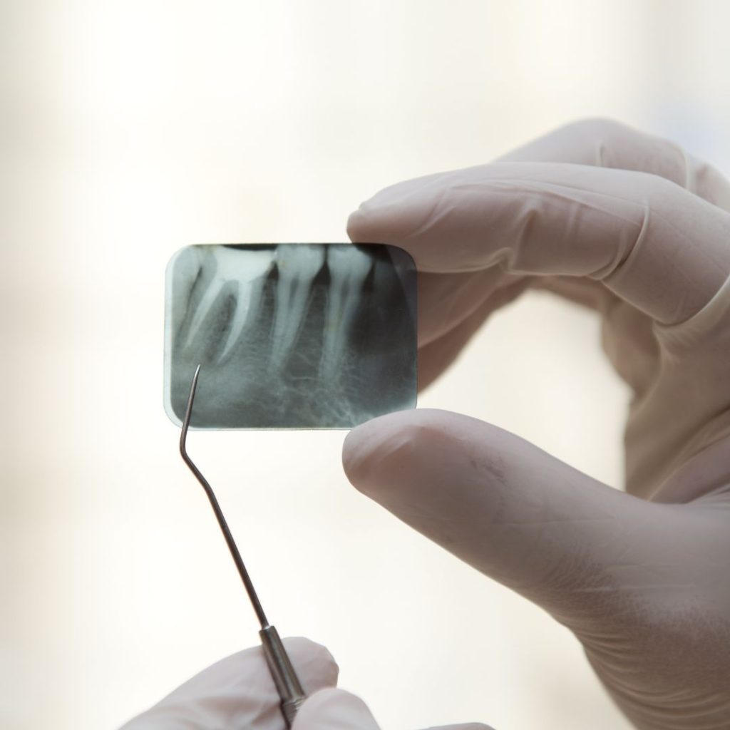 Endodonzia 1 devitalizzazione dente a Crema