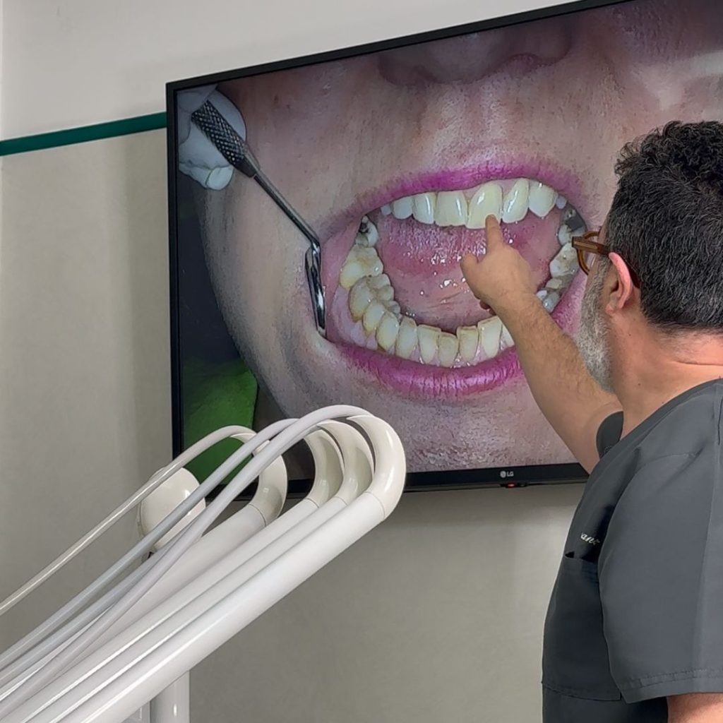 Faccette Dentali 8 FOTO CI PRENDIAMO CURA DI TE - Dentista a Crema