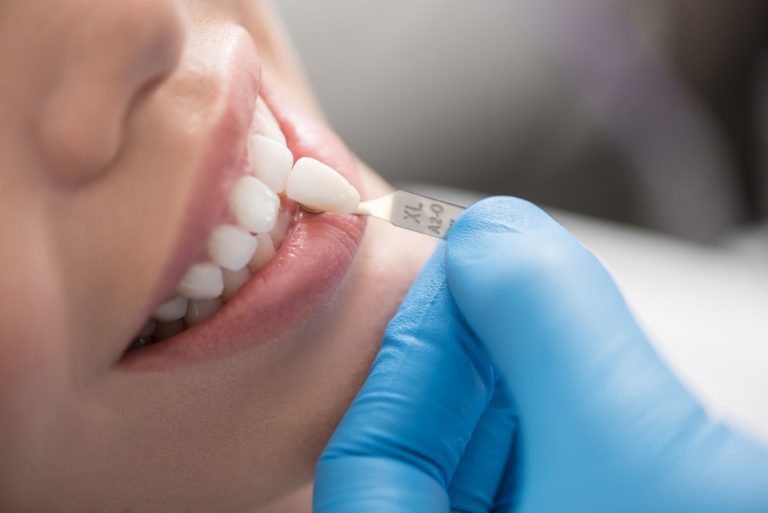 Blog 1 Quando mettere le faccette dentali