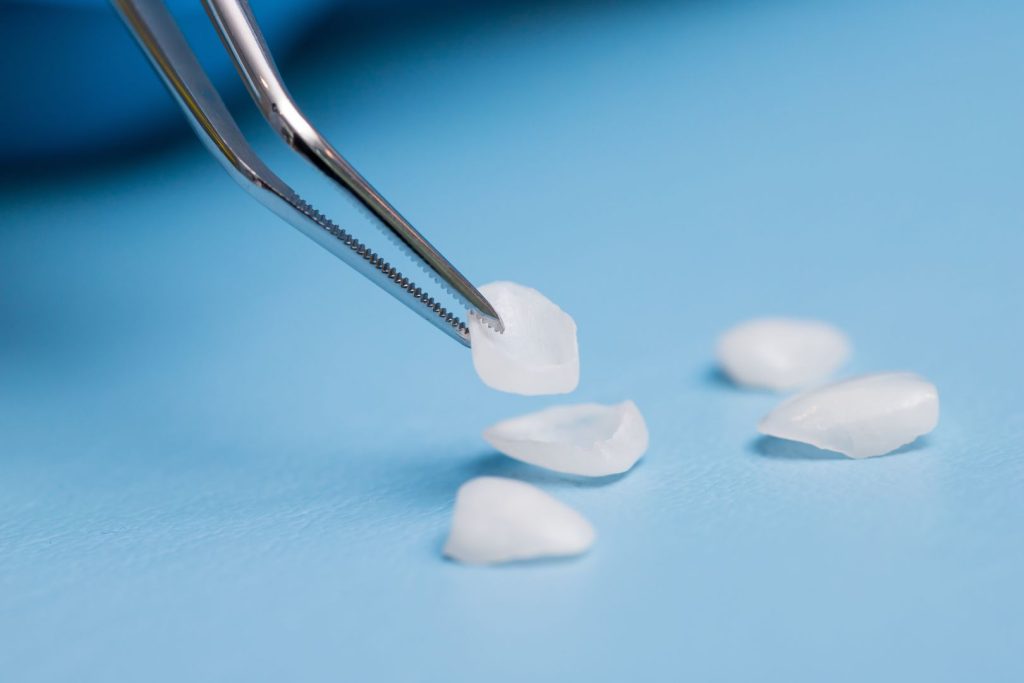 Quando mettere le faccette dentali? Guida completa per un sorriso perfetto 1 Quando mettere le faccette dentali