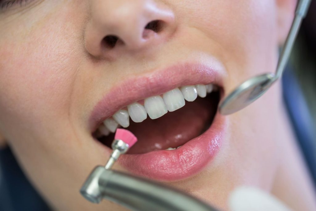Come avviene la pulizia dei denti dal dentista 1 Come avviene la pulizia dei denti dal dentista
