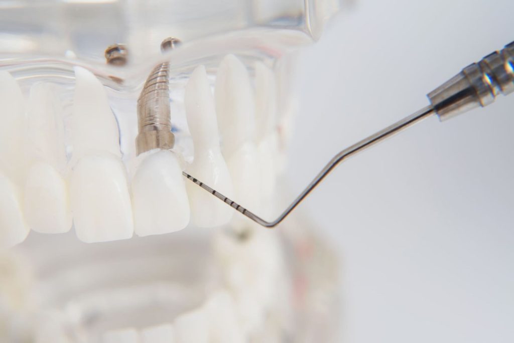 Cosa fare dopo un impianto dentale: tutti i consigli per un recupero senza problemi 1 Cosa fare dopo un impianto dentale