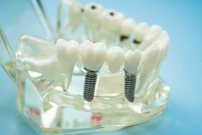 quanto dura un intervento di implantologia