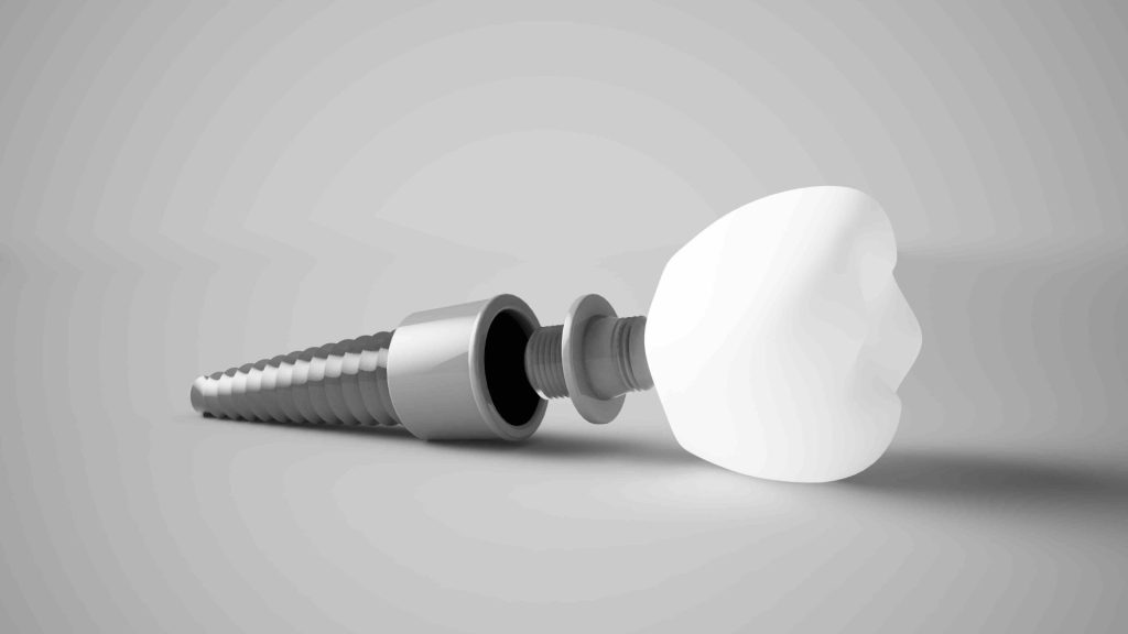 Quanto dura il dolore dopo impianto dentale? Risposte e consigli 1 Quanto dura il dolore dopo impianto dentale